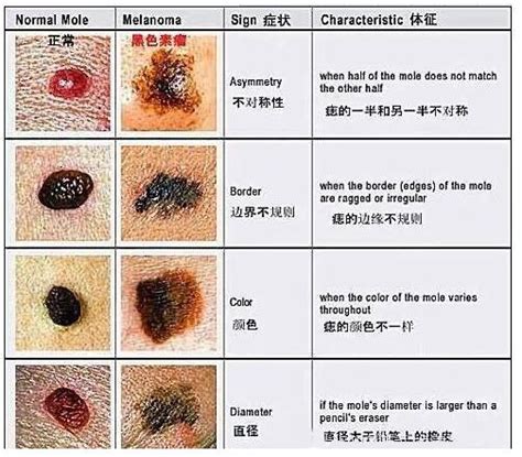 腰上长痣|腰上长了个凸起的黑痣怎么回事怎么办